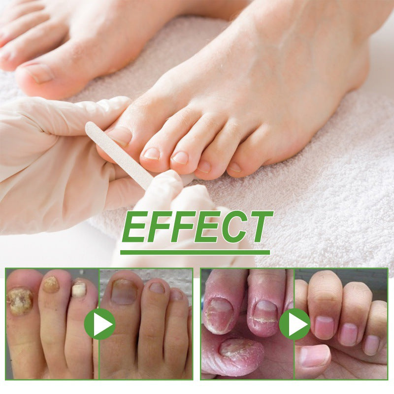 South Moon 5-day nail repair roller repairs onychomycosis, soft nails, bright nails, thickening nail care liquid